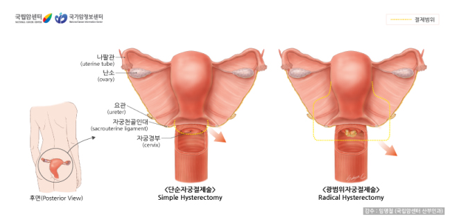 단순자궁절제술과 광범위자궁절제술 단순자궁절제술과 광범위자궁절제술