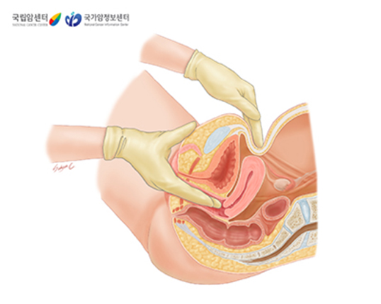 골반내진검사 골반내진검사
