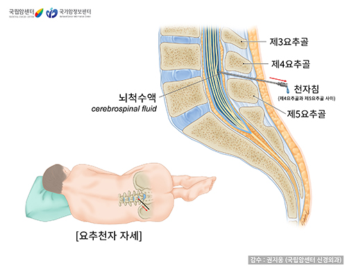 요추천자 시 자세와 천자 부위