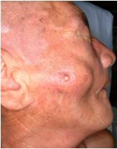 우측이하선에 발생한 진행암