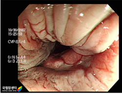 항문암의 대장내시경 소견