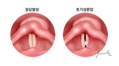초기 성문암에서 목소리가 변화는 기전