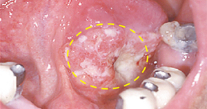 혀의 아랫면에 발생한 편평상피세포암