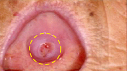 입천장에 발생한 침샘암
