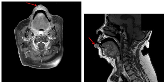 아랫입술에 발생한 구순암(화살표)의 자기공명영상(MRI) (T1)