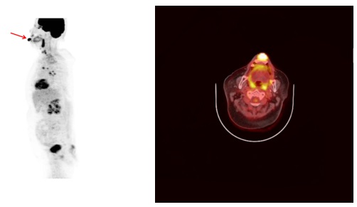 아랫입술에 발생한 구순암의 양전자방출단층촬영(PET) 영상