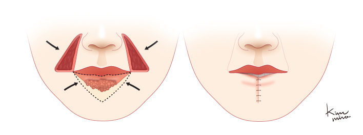 아랫입술이 거의 대부분 절제된 경우 윗입술을 양 옆에서 삼각형으로 절제해 낸 후 아랫입술을 중앙으로 당겨서 봉합하는 Bernard의 방법