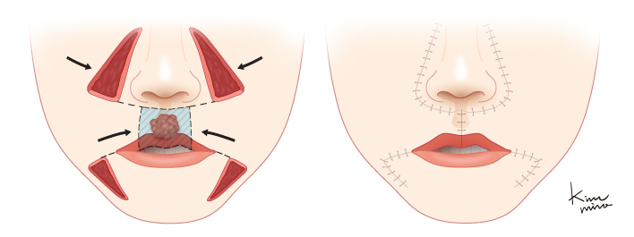 윗입술에 사각형 모양의 큰 결손부가 있을 때 Fries의 방법으로 재건하는 모습