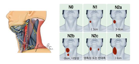 구인두-하인두암(HPV 비관련) 병기
