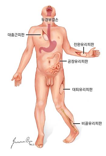 두경부암 수술 후 결손부위의 재건 (이식술)