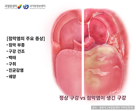 점막염(mucositis)