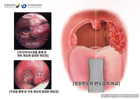 정상편도와 편도암의 비교