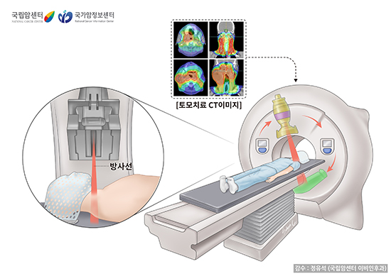 토모치료(tomotherapy)